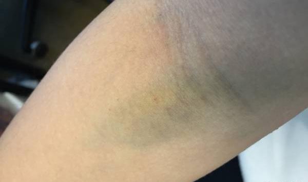 عکس کبودی پشت ساق پا
