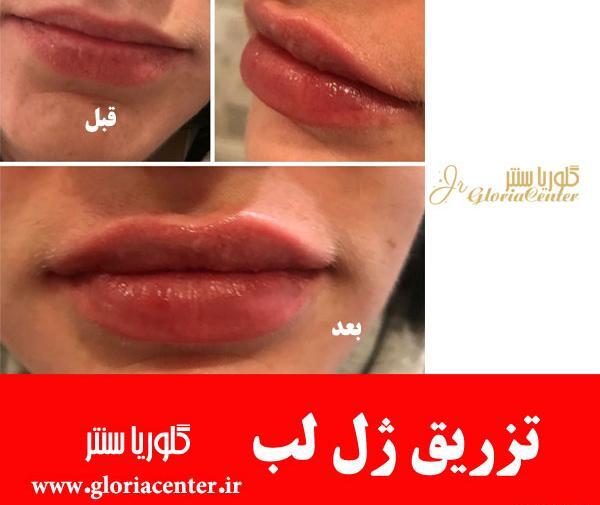 عکس کبودی لب بعد از تزریق ژل