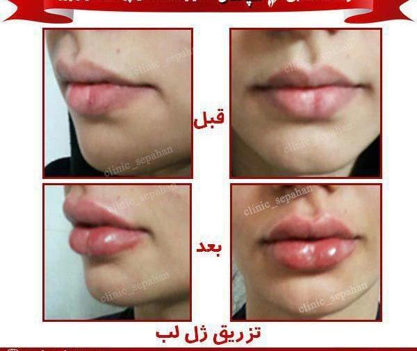 عکس کبودی لب بعد از تزریق ژل