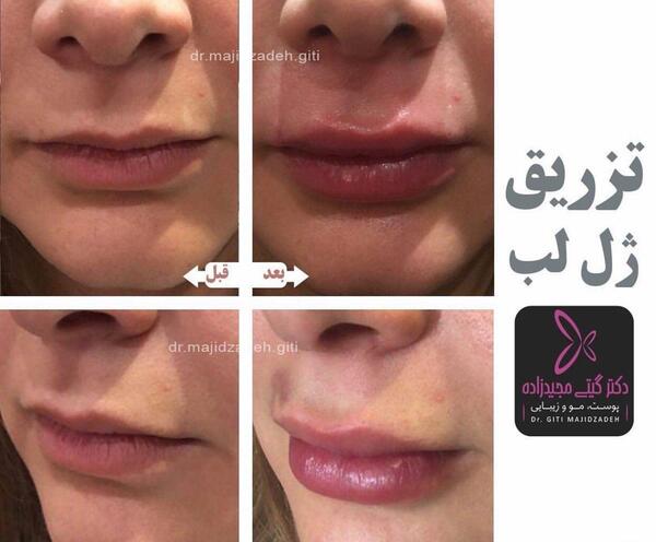 عکس کبودی لب بعد از تزریق ژل