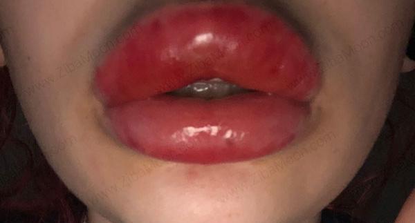 عکس کبودی لب بعد از تزریق ژل