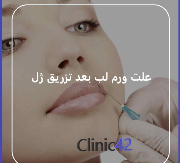 عکس کبودی لب بعد از تزریق ژل