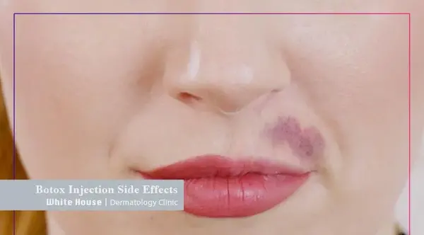 عکس کبودی لب بعد از تزریق ژل