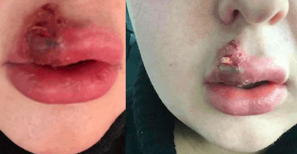 عکس کبودی لب بعد از تزریق ژل