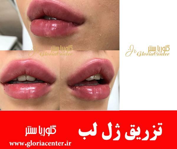 عکس کبودی لب بعد از تزریق ژل