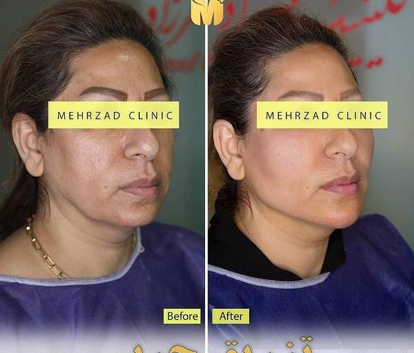 عکس کبودی صورت بعد از تزریق چربی