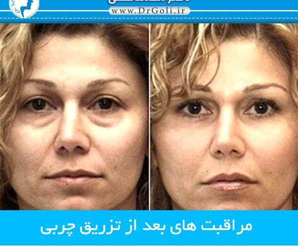 عکس کبودی صورت بعد از تزریق چربی