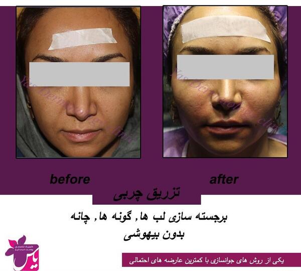 عکس کبودی صورت بعد از تزریق چربی