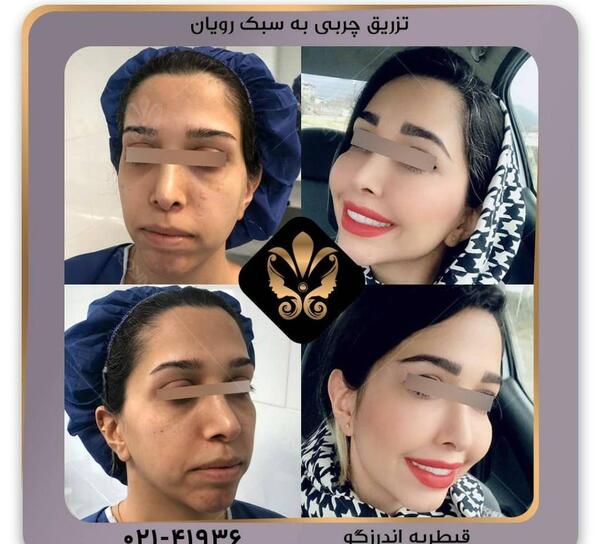 عکس کبودی صورت بعد از تزریق چربی