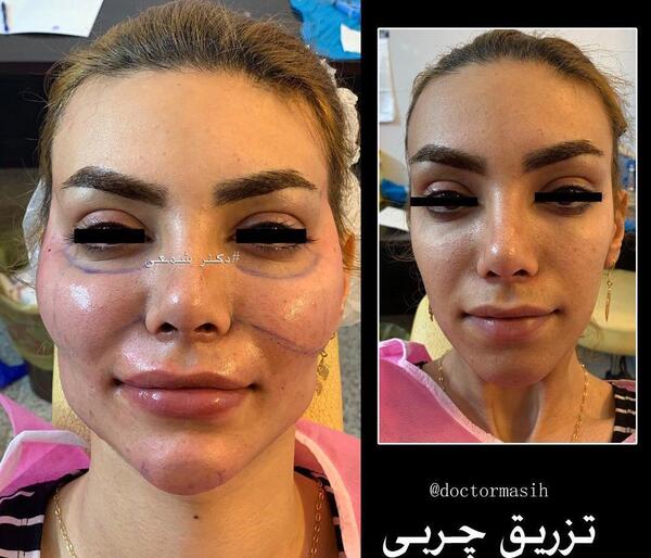 عکس کبودی صورت بعد از تزریق چربی