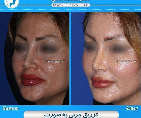 عکس کبودی صورت بعد از تزریق چربی