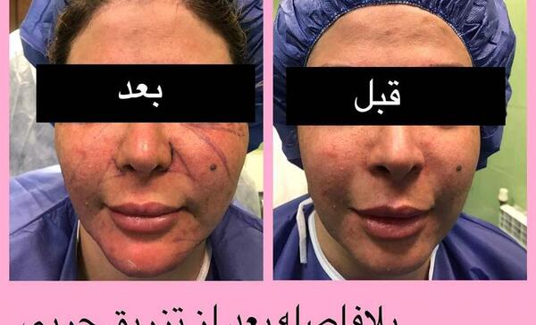 عکس کبودی صورت بعد از تزریق چربی