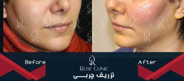 عکس کبودی صورت بعد از تزریق چربی