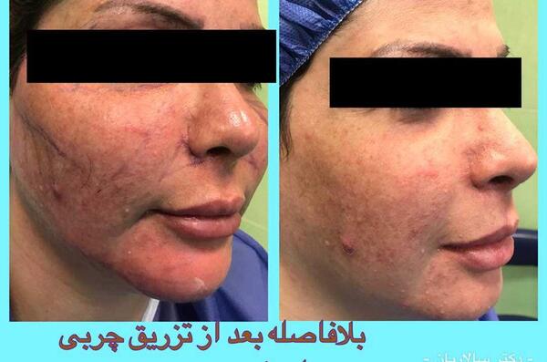 عکس کبودی صورت بعد از تزریق چربی
