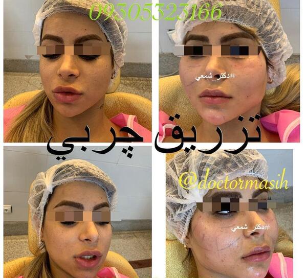 عکس کبودی صورت بعد از تزریق چربی