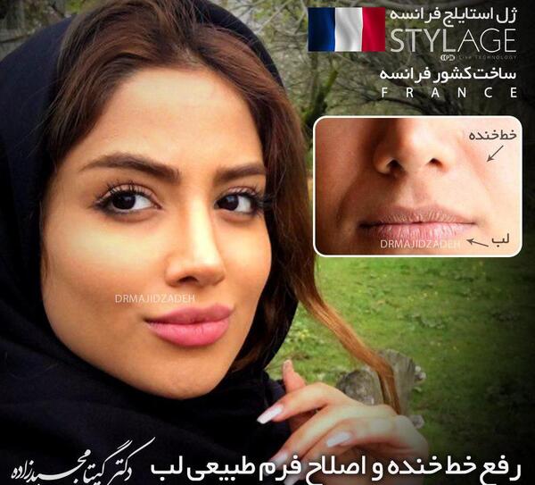 عکس کبودی صورت بعد از تزریق چربی