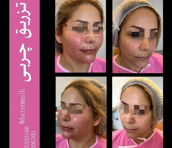 عکس کبودی صورت بعد از تزریق چربی