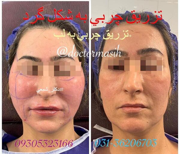 عکس کبودی صورت بعد از تزریق چربی
