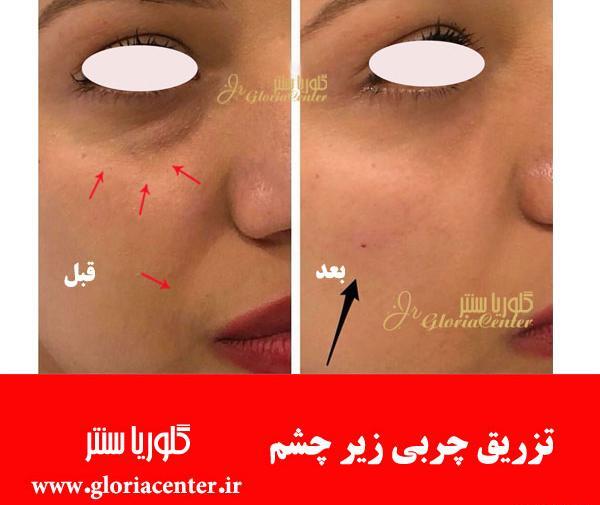 عکس کبودی صورت بعد از تزریق چربی