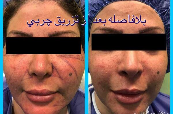 عکس کبودی صورت بعد از تزریق چربی