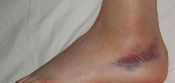 عکس کبودی کتک خوردن
