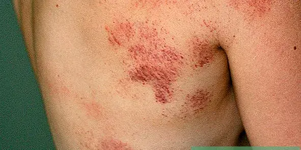 عکس کبودی دنده