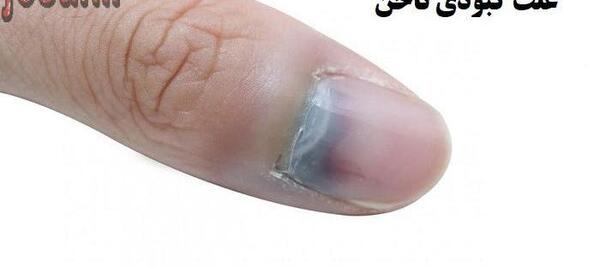 عکس ناخن کبود
