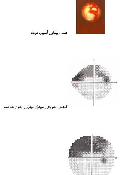 عکس چشم آسیب دیده