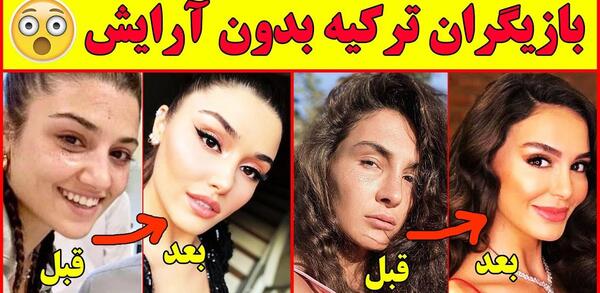 عکس قبل عمل الچین سانگو