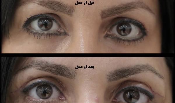 عکس قبل و بعد عمل افتادگی پلک