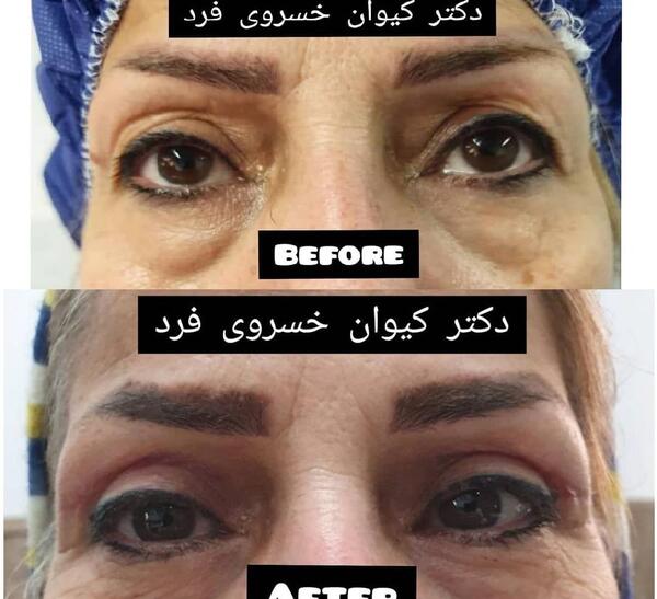 عکس قبل و بعد عمل افتادگی پلک