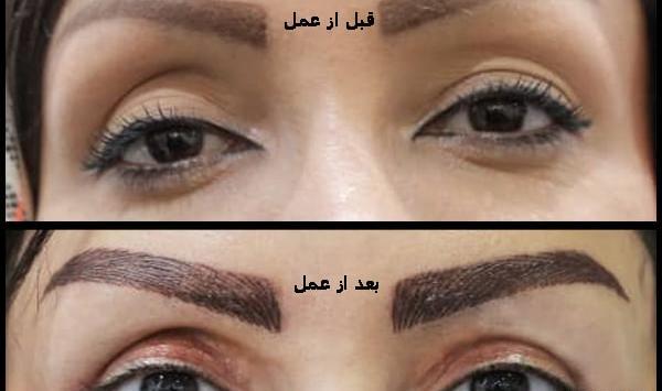عکس قبل و بعد عمل افتادگی پلک