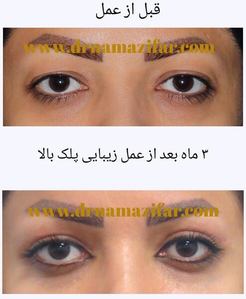 عکس قبل و بعد عمل افتادگی پلک