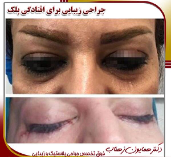 عکس قبل و بعد عمل افتادگی پلک