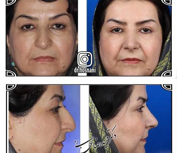 عکس قبل و بعد عمل افتادگی پلک