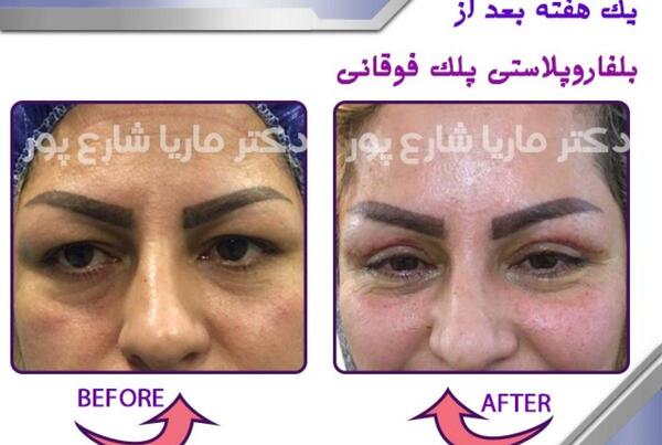 عکس قبل و بعد عمل افتادگی پلک