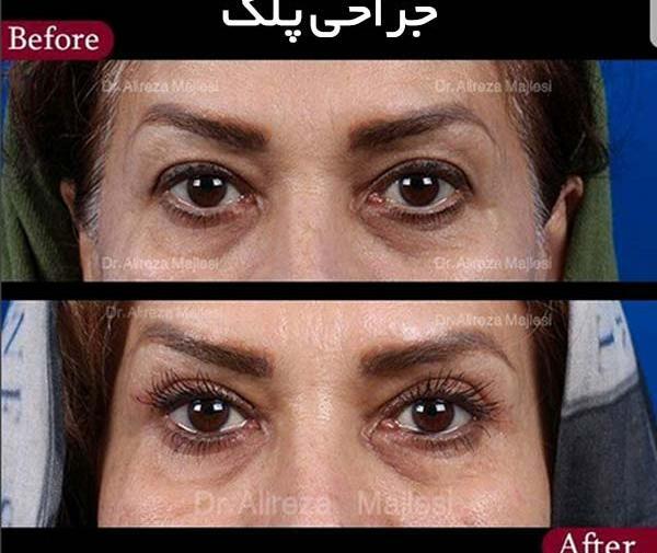 عکس قبل و بعد عمل افتادگی پلک