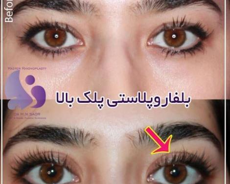 عکس قبل و بعد عمل افتادگی پلک