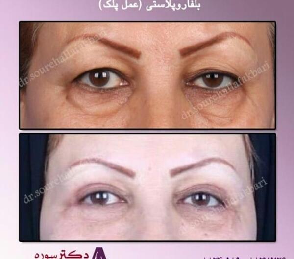 عکس قبل و بعد عمل افتادگی پلک