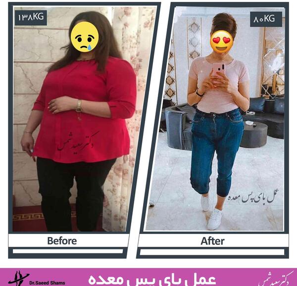 عکس قبل بعد لاغری