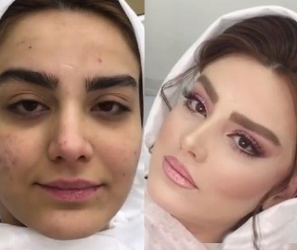 عکس قبل بعد عروس
