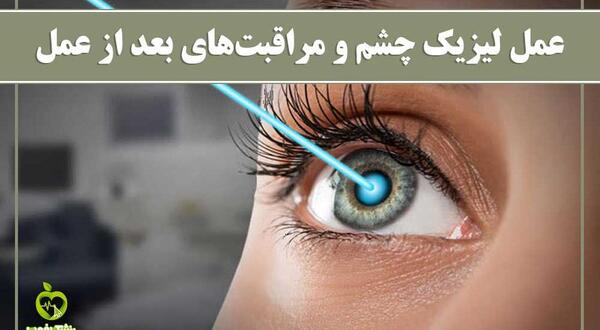 عکس چشم قبل از لیزیک
