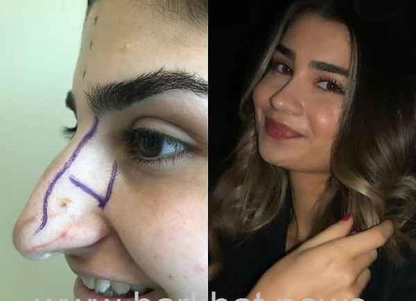 عکس دماغ قبل و بعد عمل