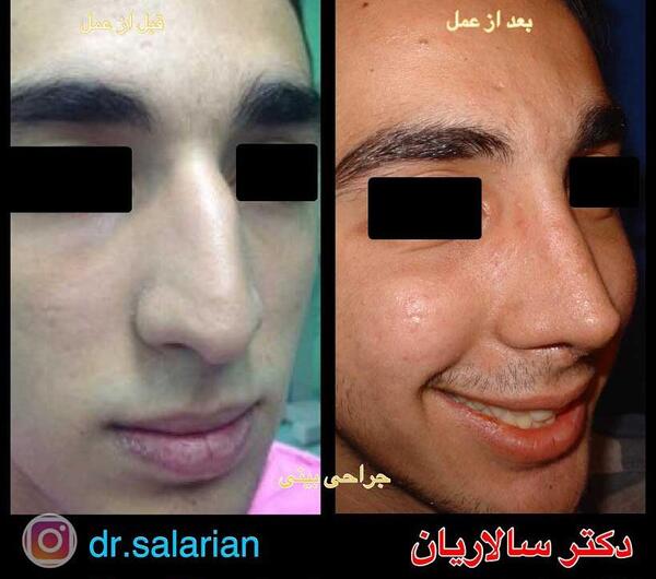 عکس دماغ قبل و بعد عمل