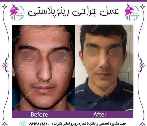 عکس دماغ قبل و بعد عمل
