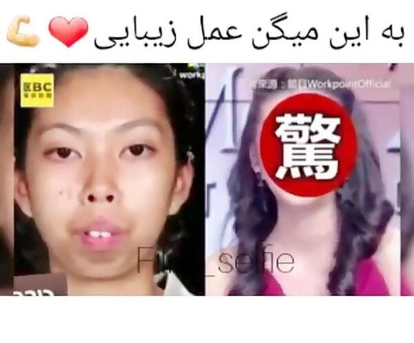 عکس رزی قبل از عمل
