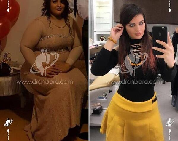 عکس صورت قبل و بعد لاغری