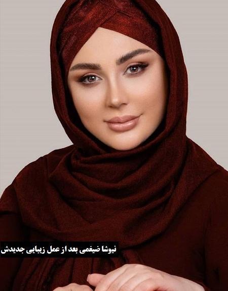 عکس نیوشا ضیغمی قبل و بعد از عمل بینی