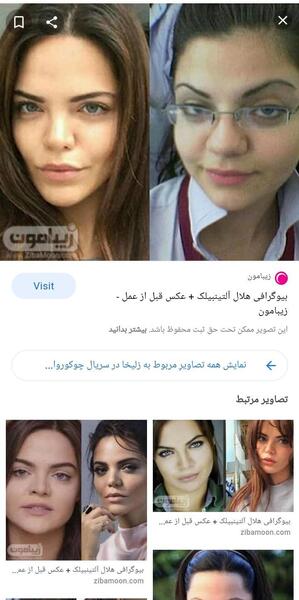 عکس قبل عمل هلال آلتینبیلک