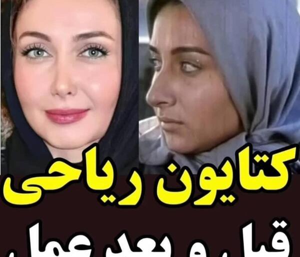 عکس قبل عمل هلال آلتینبیلک
